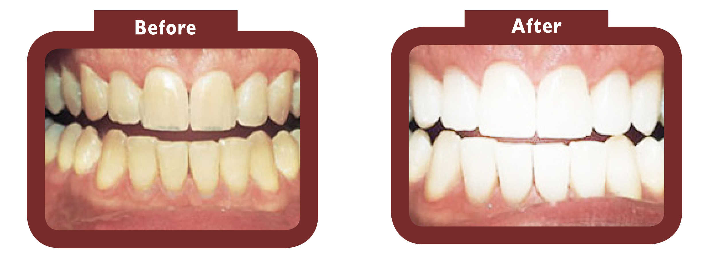 before and after teeth whitening - LA TEETH Northamptonshire