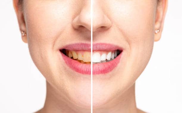 Teeth Whitening Milton Keynes Northamptonshire