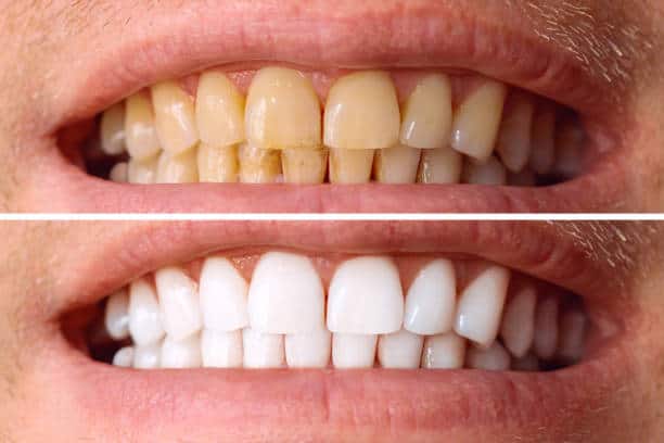 Laser White For Ever Bright – Get a Brighter, Whiter Smile with LA Teeth Whitening Northamptonshire