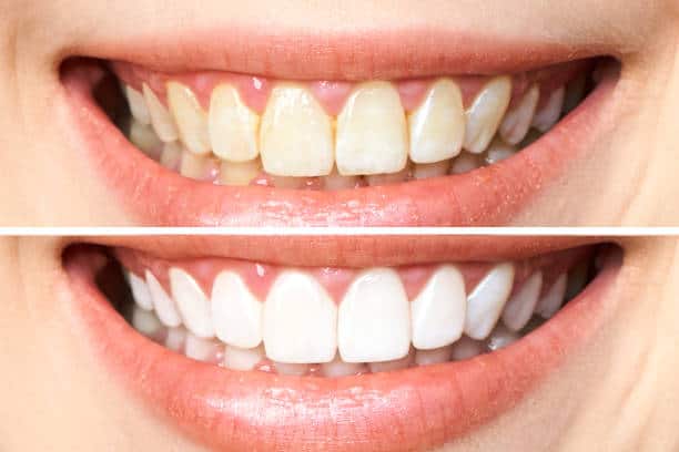 Achieve a Dazzling Smile for Your Special Day: A Guide to Wedding Teeth Whitening Northamptonshire