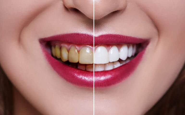 Teeth Whitening Ascot Windsor Northamptonshire