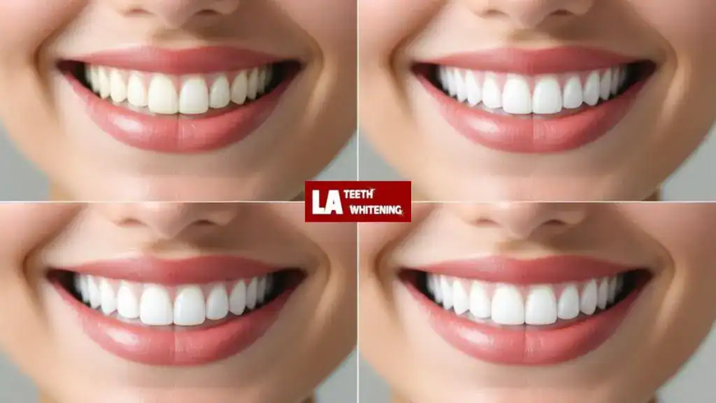 Whitening Before or After Getting Veneers: What’s Best Northamptonshire